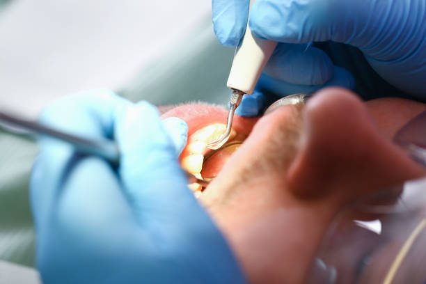 Best Emergency Treatment for Dental Infections or Abscesses in South Palm Beach, FL